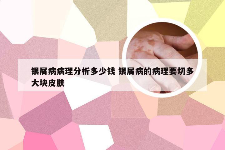 银屑病病理分析多少钱 银屑病的病理要切多大块皮肤