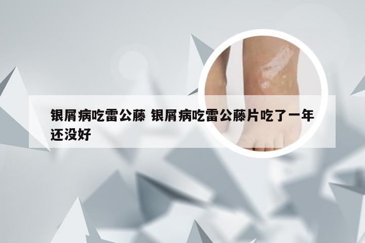 银屑病吃雷公藤 银屑病吃雷公藤片吃了一年还没好