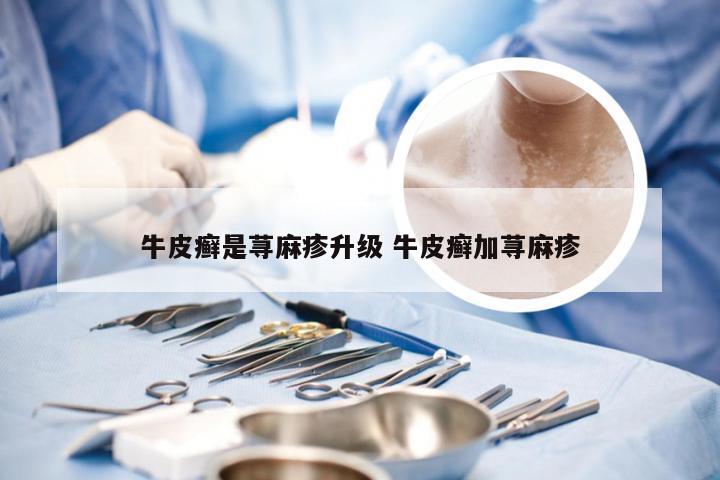 牛皮癣是荨麻疹升级 牛皮癣加荨麻疹