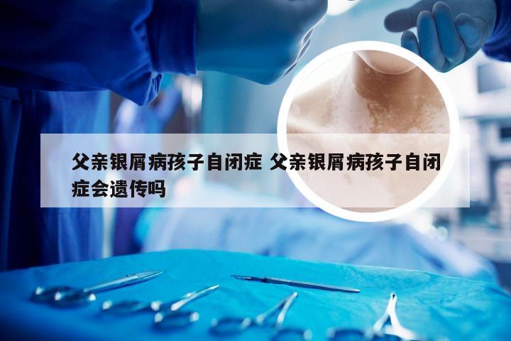 父亲银屑病孩子自闭症 父亲银屑病孩子自闭症会遗传吗