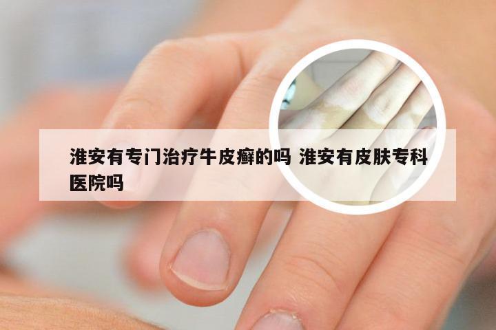 淮安有专门治疗牛皮癣的吗 淮安有皮肤专科医院吗
