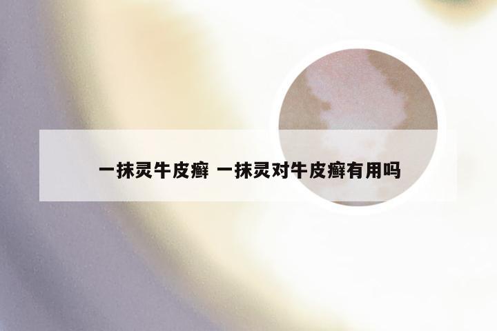 一抹灵牛皮癣 一抹灵对牛皮癣有用吗