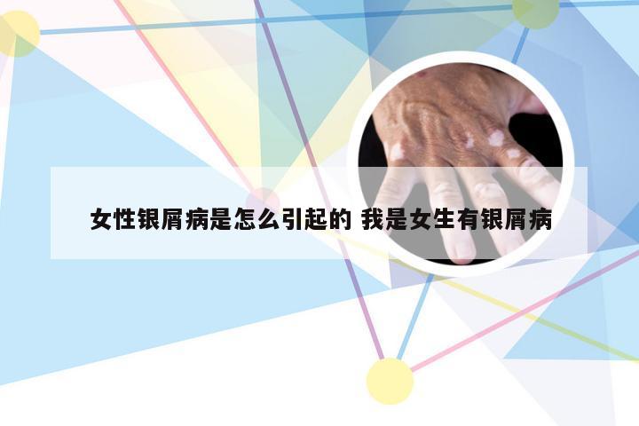 女性银屑病是怎么引起的 我是女生有银屑病