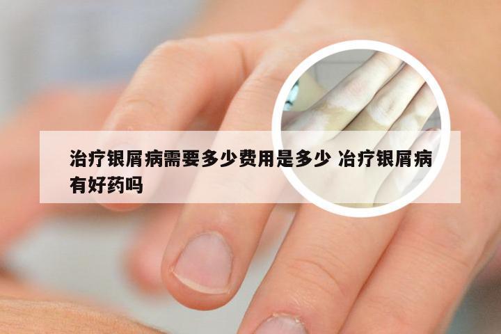 治疗银屑病需要多少费用是多少 冶疗银屑病有好药吗