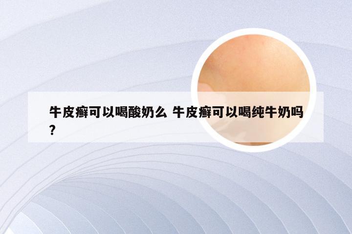 牛皮癣可以喝酸奶么 牛皮癣可以喝纯牛奶吗?