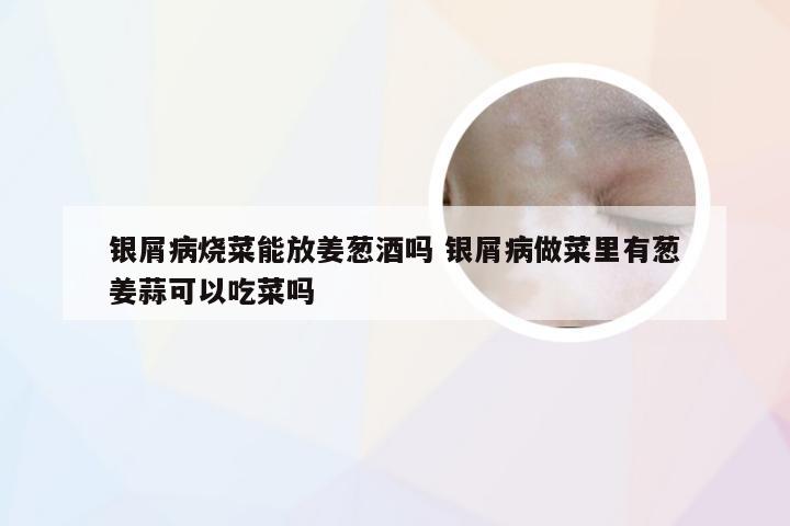 银屑病烧菜能放姜葱酒吗 银屑病做菜里有葱姜蒜可以吃菜吗