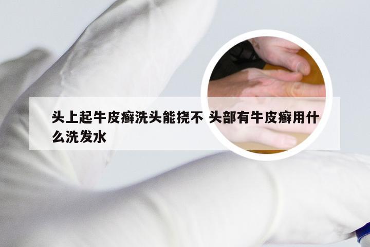 头上起牛皮癣洗头能挠不 头部有牛皮癣用什么洗发水