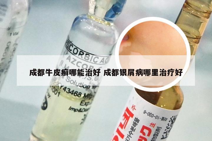 成都牛皮癣哪能治好 成都银屑病哪里治疗好