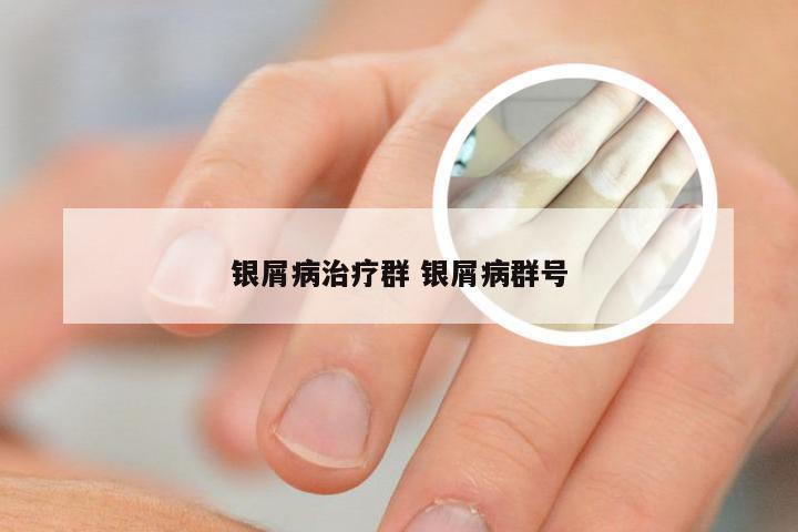 银屑病治疗群 银屑病群号