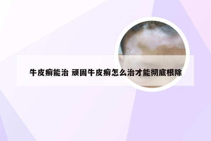 牛皮癣能治 顽固牛皮癣怎么治才能彻底根除