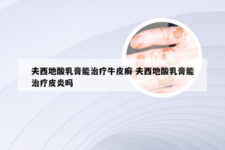 夫西地酸乳膏能治疗牛皮癣 夫西地酸乳膏能治疗皮炎吗