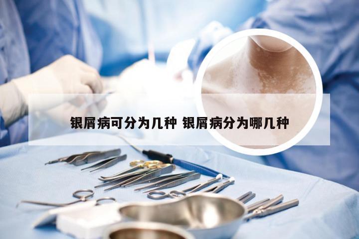 银屑病可分为几种 银屑病分为哪几种