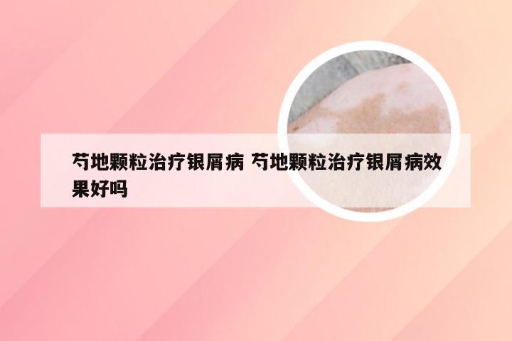 芍地颗粒治疗银屑病 芍地颗粒治疗银屑病效果好吗