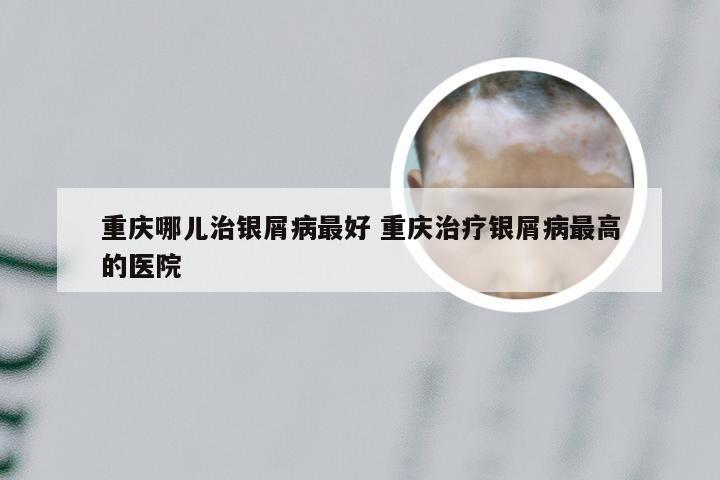 重庆哪儿治银屑病最好 重庆治疗银屑病最高的医院