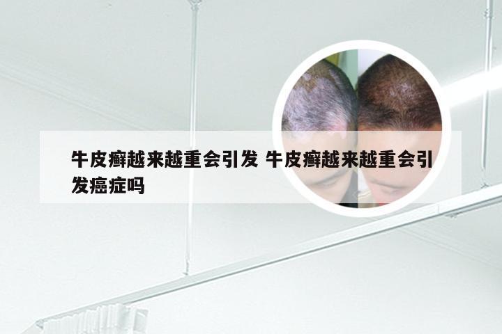 牛皮癣越来越重会引发 牛皮癣越来越重会引发癌症吗