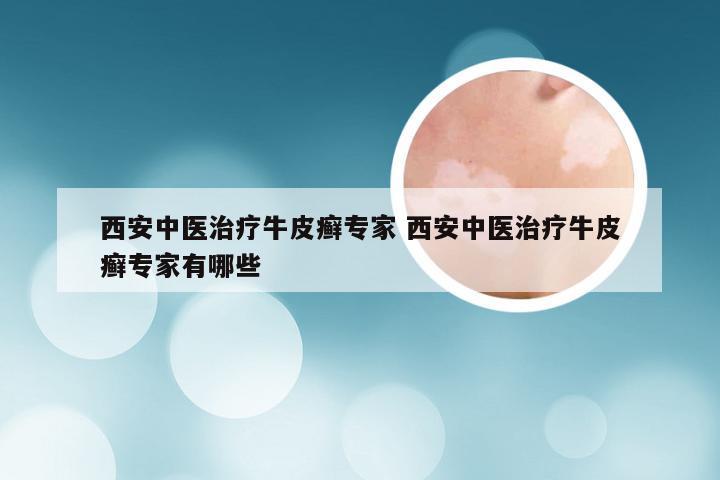 西安中医治疗牛皮癣专家 西安中医治疗牛皮癣专家有哪些