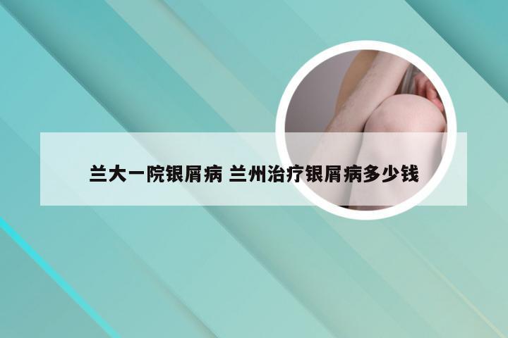兰大一院银屑病 兰州治疗银屑病多少钱