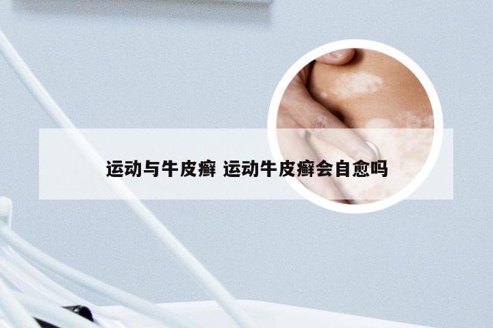运动与牛皮癣 运动牛皮癣会自愈吗