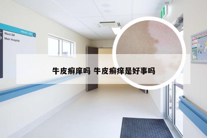 牛皮癣庠吗 牛皮癣痒是好事吗