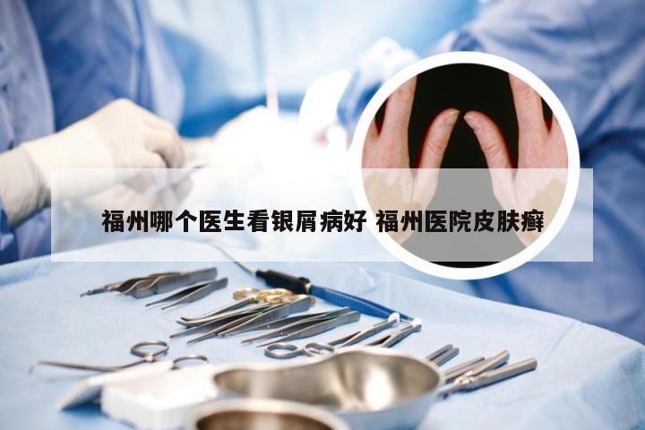 福州哪个医生看银屑病好 福州医院皮肤癣