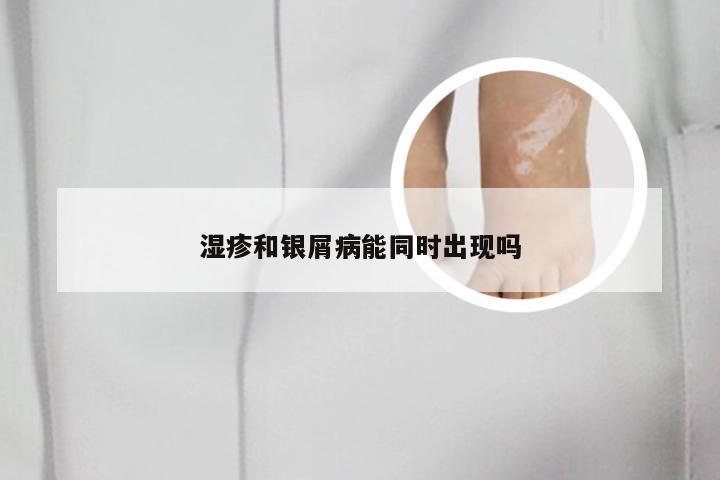 湿疹和银屑病能同时出现吗