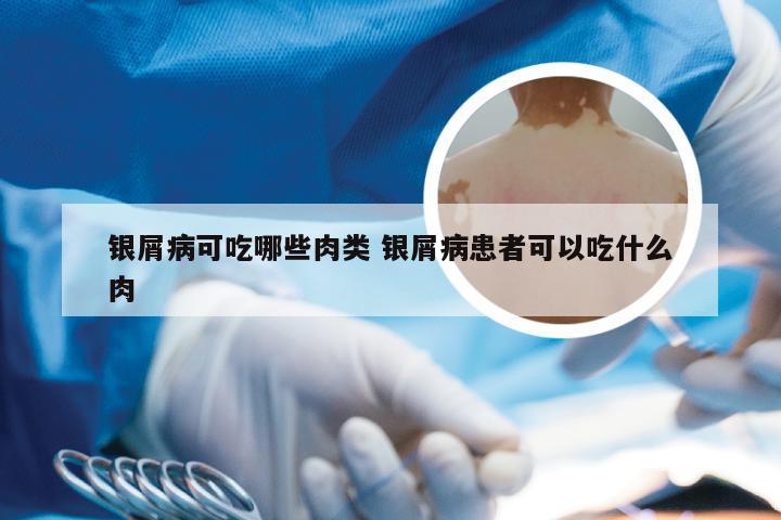银屑病可吃哪些肉类 银屑病患者可以吃什么肉