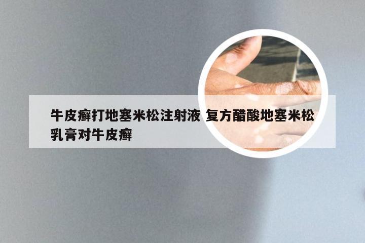 牛皮癣打地塞米松注射液 复方醋酸地塞米松乳膏对牛皮癣