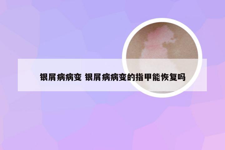 银屑病病变 银屑病病变的指甲能恢复吗