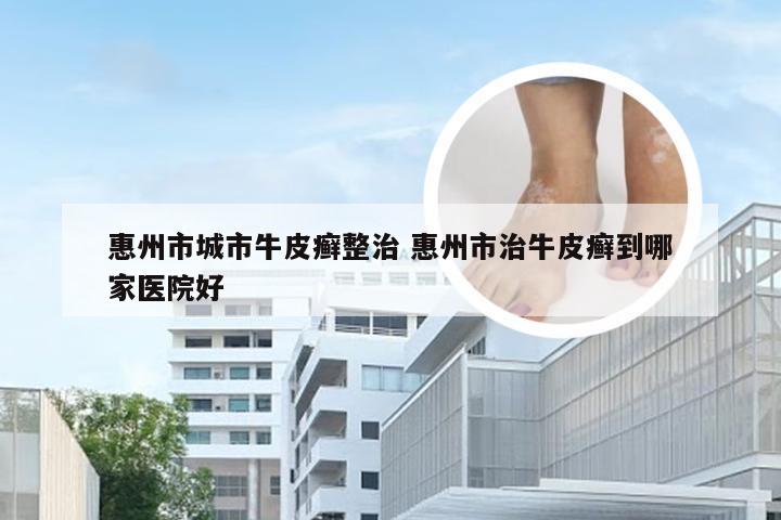 惠州市城市牛皮癣整治 惠州市治牛皮癣到哪家医院好