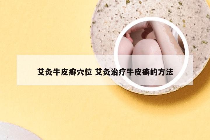 艾灸牛皮癣穴位 艾灸治疗牛皮癣的方法