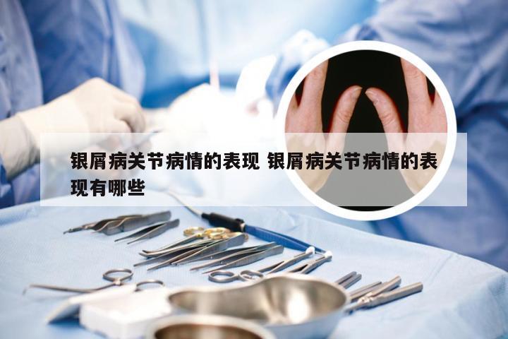 银屑病关节病情的表现 银屑病关节病情的表现有哪些