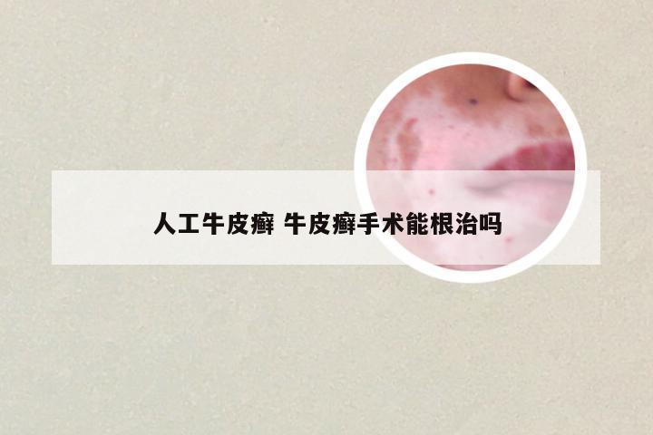 人工牛皮癣 牛皮癣手术能根治吗
