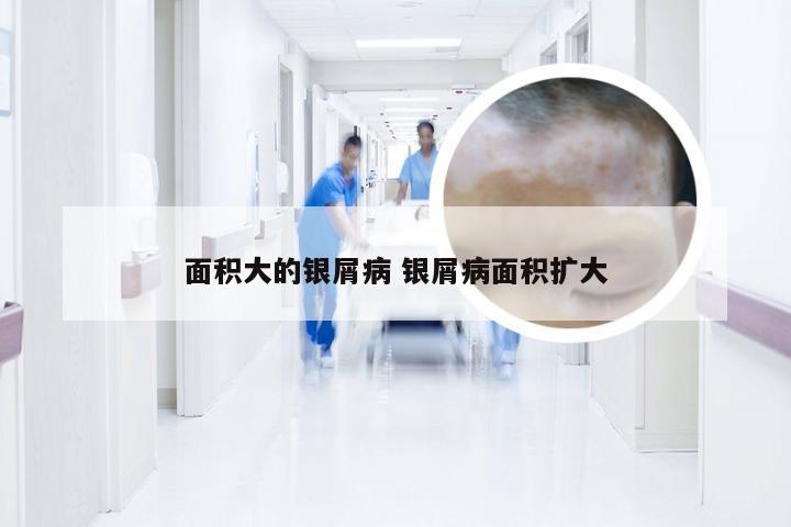 面积大的银屑病 银屑病面积扩大