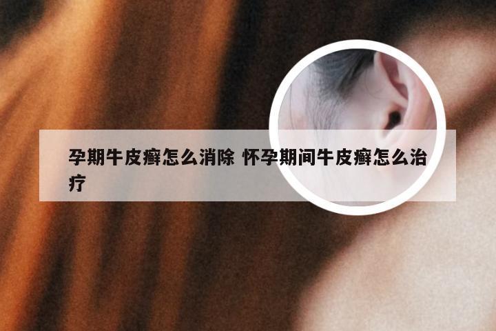 孕期牛皮癣怎么消除 怀孕期间牛皮癣怎么治疗