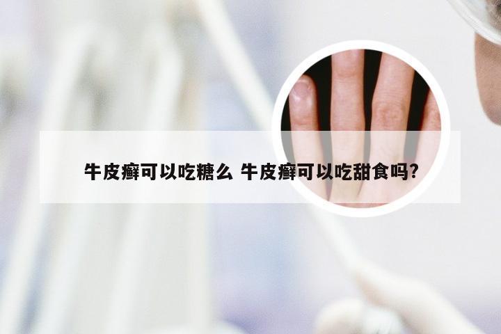 牛皮癣可以吃糖么 牛皮癣可以吃甜食吗?