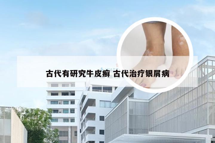 古代有研究牛皮癣 古代治疗银屑病