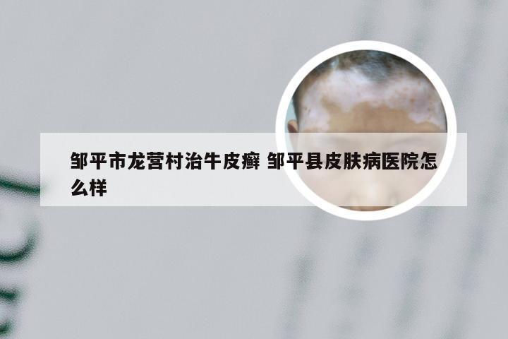 邹平市龙营村治牛皮癣 邹平县皮肤病医院怎么样