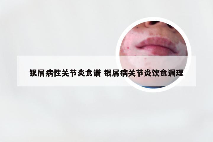银屑病性关节炎食谱 银屑病关节炎饮食调理