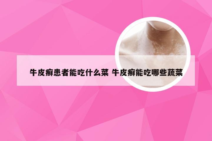 牛皮癣患者能吃什么菜 牛皮癣能吃哪些蔬菜