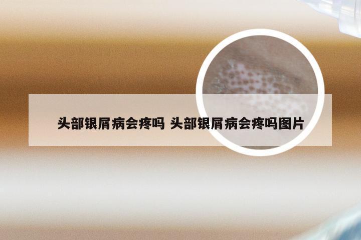 头部银屑病会疼吗 头部银屑病会疼吗图片