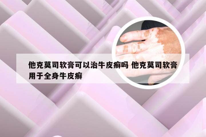 他克莫司软膏可以治牛皮癣吗 他克莫司软膏用于全身牛皮癣