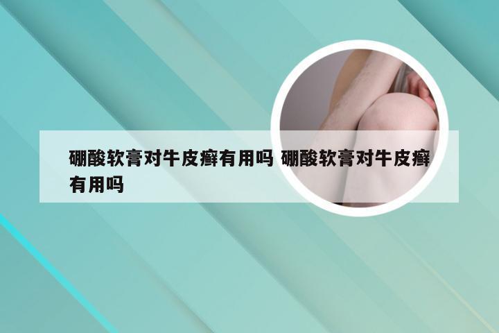 硼酸软膏对牛皮癣有用吗 硼酸软膏对牛皮癣有用吗
