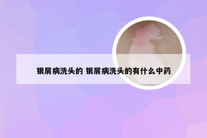 银屑病洗头的 银屑病洗头的有什么中药
