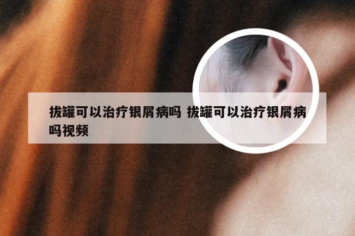 拔罐可以治疗银屑病吗 拔罐可以治疗银屑病吗视频