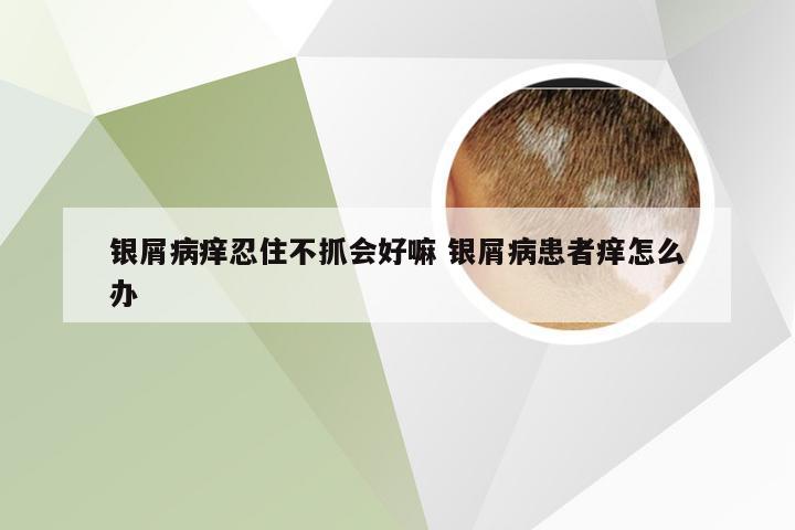银屑病痒忍住不抓会好嘛 银屑病患者痒怎么办
