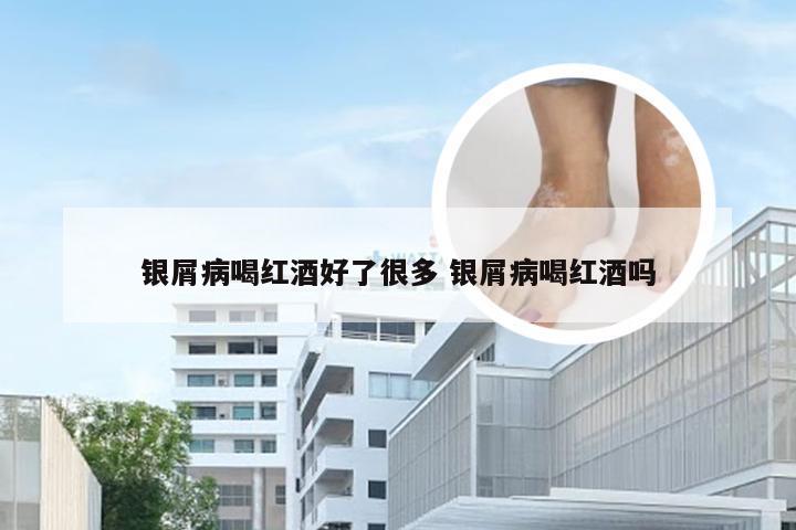 银屑病喝红酒好了很多 银屑病喝红酒吗