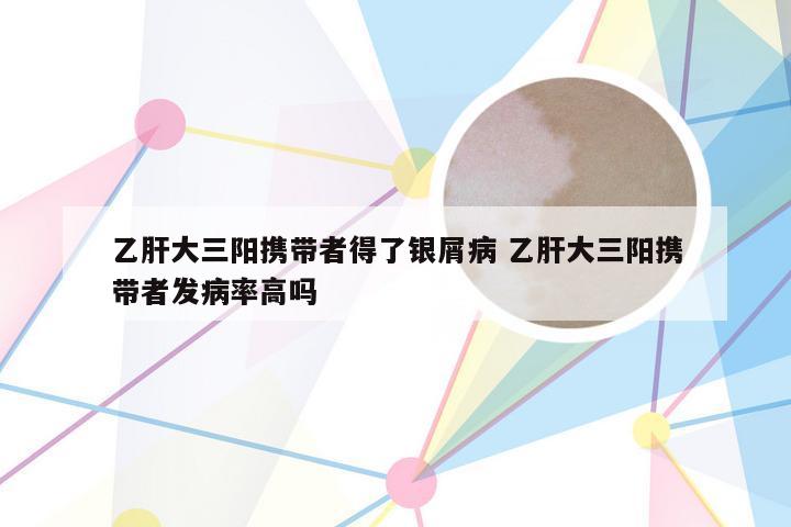 乙肝大三阳携带者得了银屑病 乙肝大三阳携带者发病率高吗