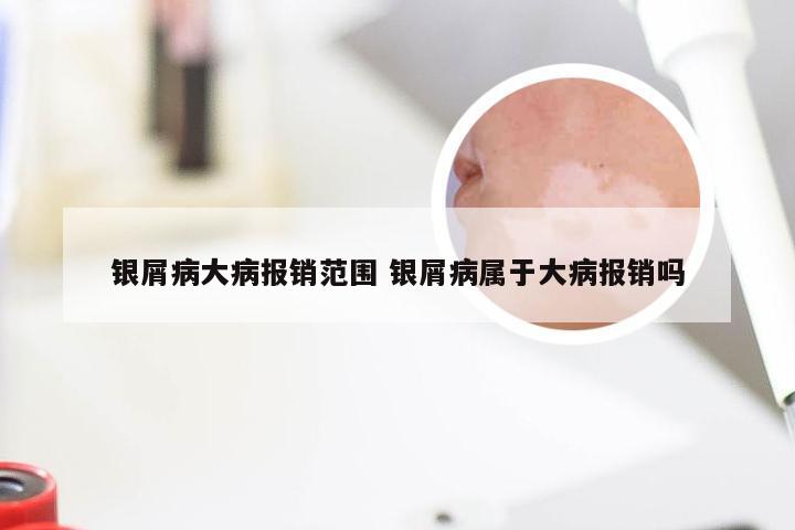银屑病大病报销范围 银屑病属于大病报销吗