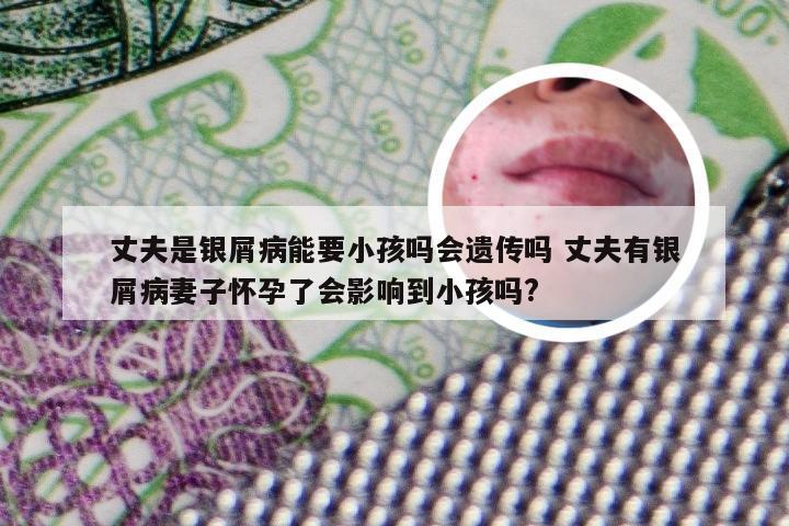 丈夫是银屑病能要小孩吗会遗传吗 丈夫有银屑病妻子怀孕了会影响到小孩吗?