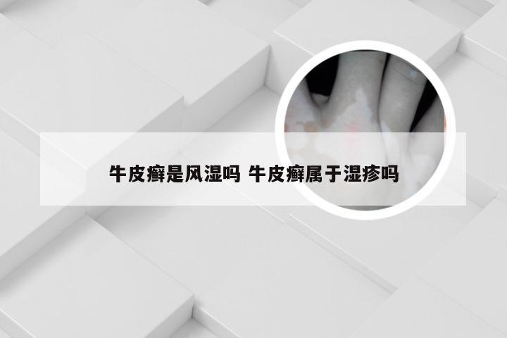 牛皮癣是风湿吗 牛皮癣属于湿疹吗